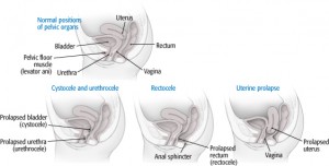 bladder-rectal-repair